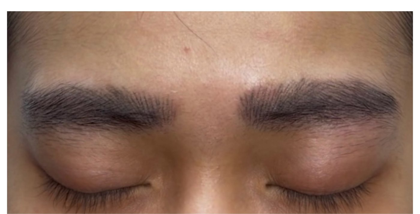 Brows before PMU removal