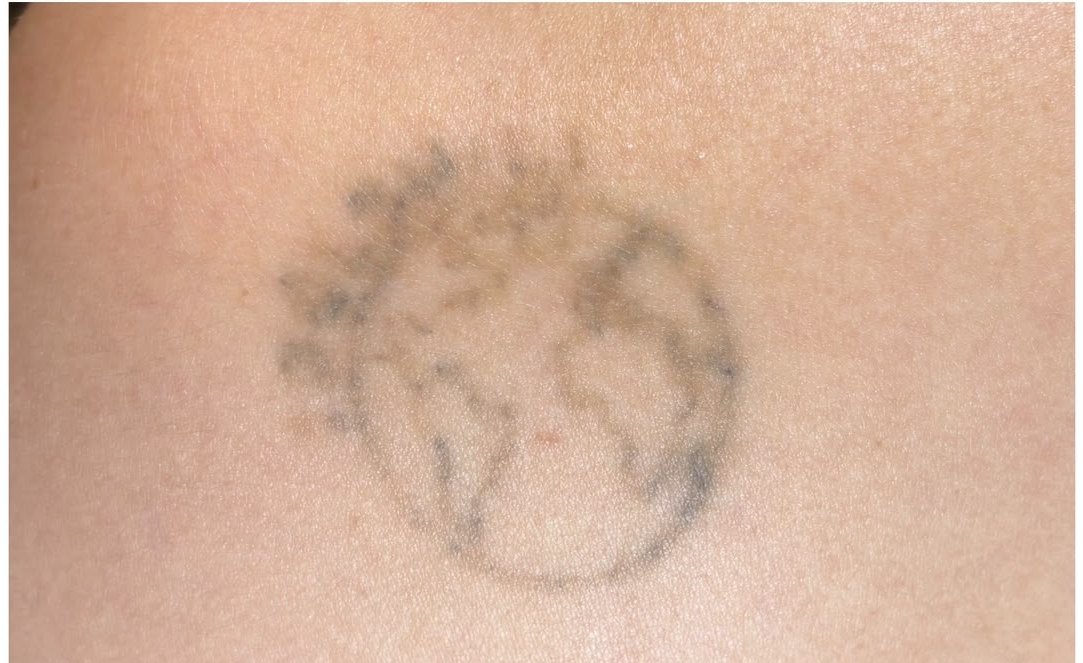 Same shoulder tattoo after eight months of treatment