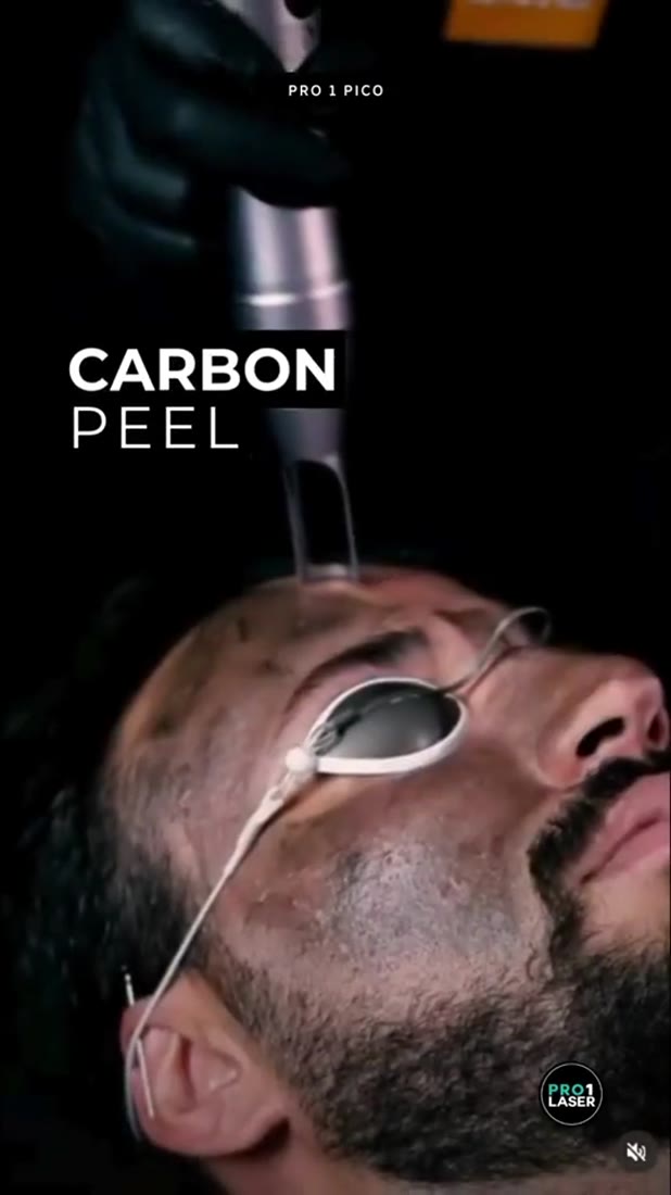 Carbon laser peel in progress
